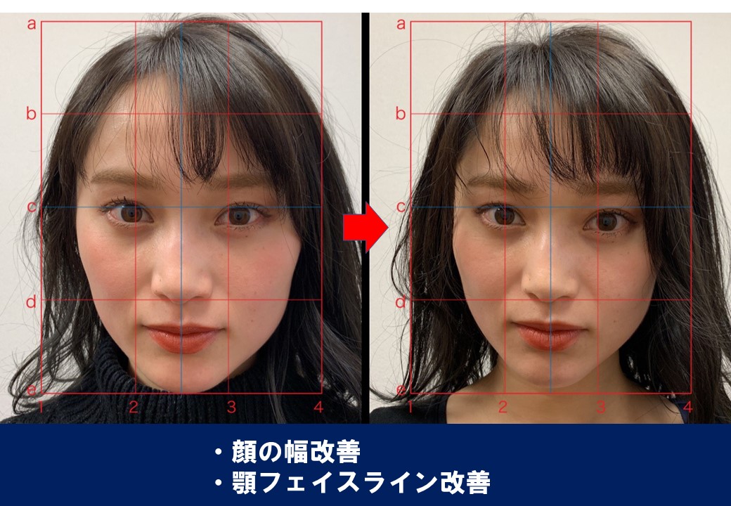 顔の幅改善・顎のフェイスライン改善