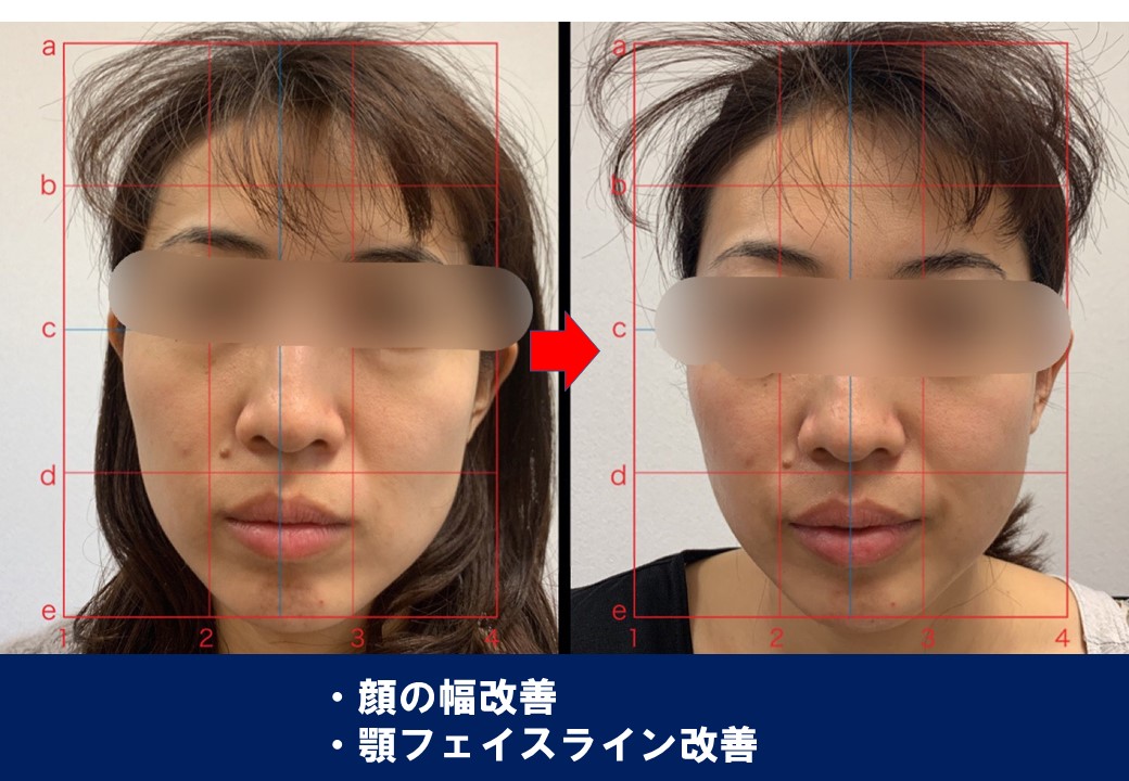 顔の幅改善・顎のフェイスライン改善