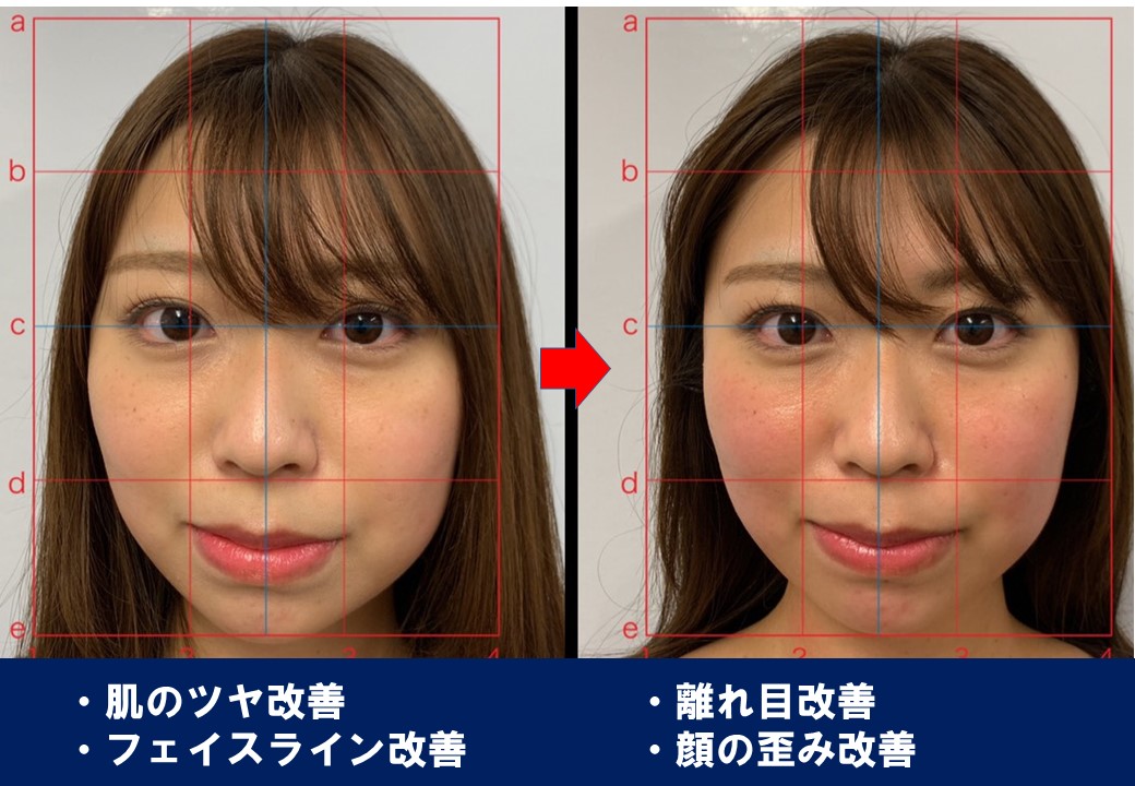 肌艶改善・離れ目改善・フェイスライン改善・顔の歪み改善