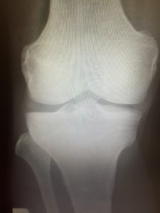 変形性膝関節症の原因